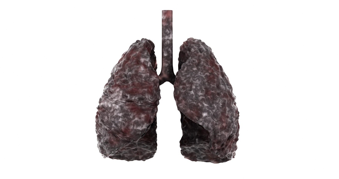 3D渲染的肺部病变过程视频素材