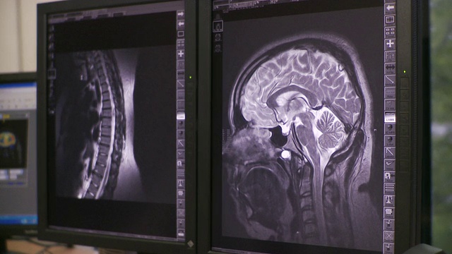 CU电脑屏幕上的几张x射线和CT扫描图像/南伯灵顿，佛蒙特，美国视频素材