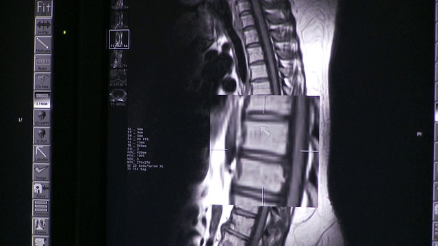 ECU PAN TD x射线和CT扫描显示在电脑屏幕上/南伯灵顿，佛蒙特，美国视频素材
