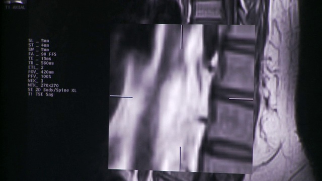 ECU TD电脑屏幕上脊柱x线图像/美国佛蒙特州南伯灵顿视频素材