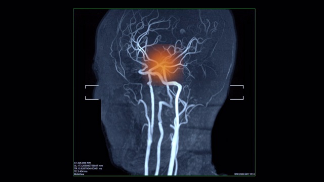 血管扫描显示中风视频素材
