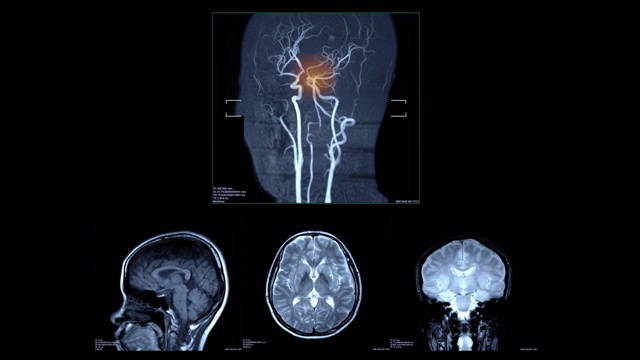 血管扫描和脑中风视频素材
