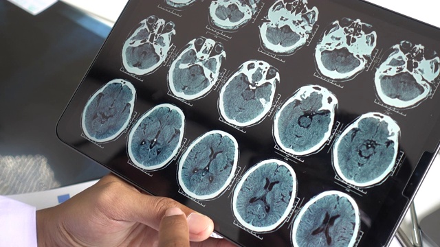 腦X線影像視頻素材