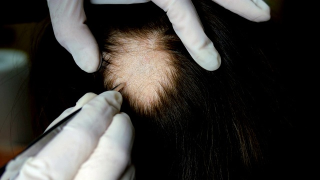 女人脱发。医生或美容师做检查，做程序，女人的头。视频素材