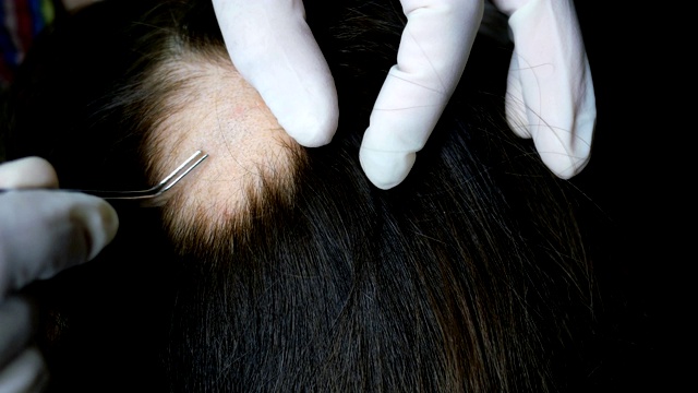女人脱发。医生或美容师做检查，做程序，女人的头。视频素材