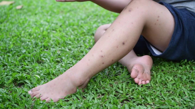 孩子被蚊子叮咬后抓伤了腿，坐在青草上。视频素材