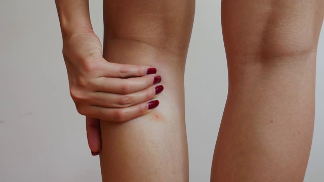 一位妇女的手涂着红色指甲，在她的腿上抓了虫子咬的地方。视频素材
