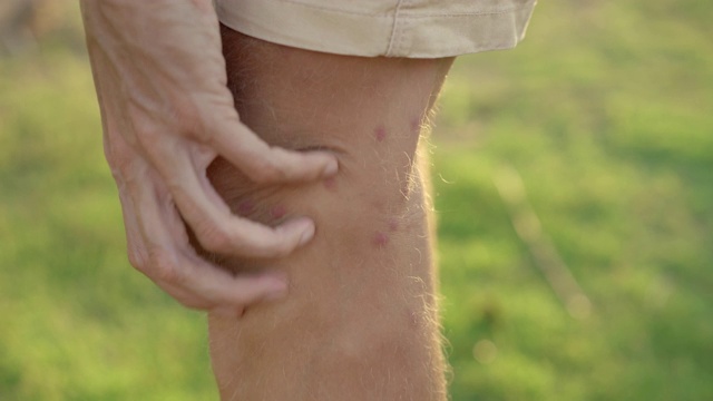 一名男子在自然环境中抓挠被蚊子严重叮咬的腿。昆虫的叮咬概念视频素材