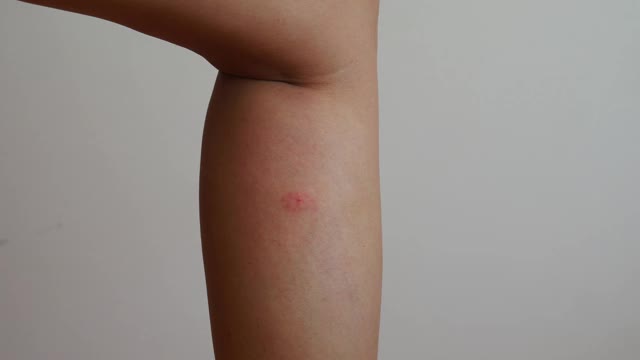 近距离观察——一个女人的腿被虫子咬了。视频素材