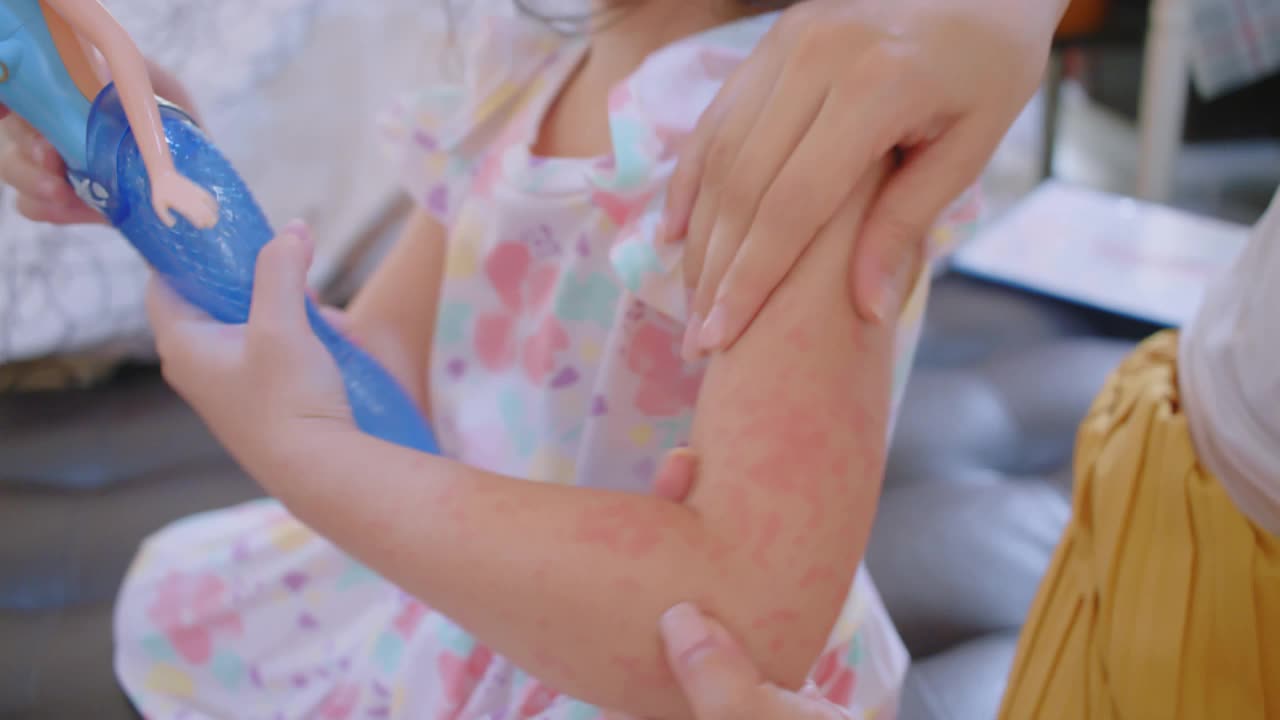 母亲在给蹒跚学步的女儿涂乳液。过敏，孩子脸颊红肿视频下载