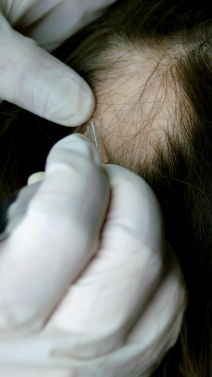 女人脱发。医生或美容师做检查，做程序，没有头发的女人皮肤的头。视频素材