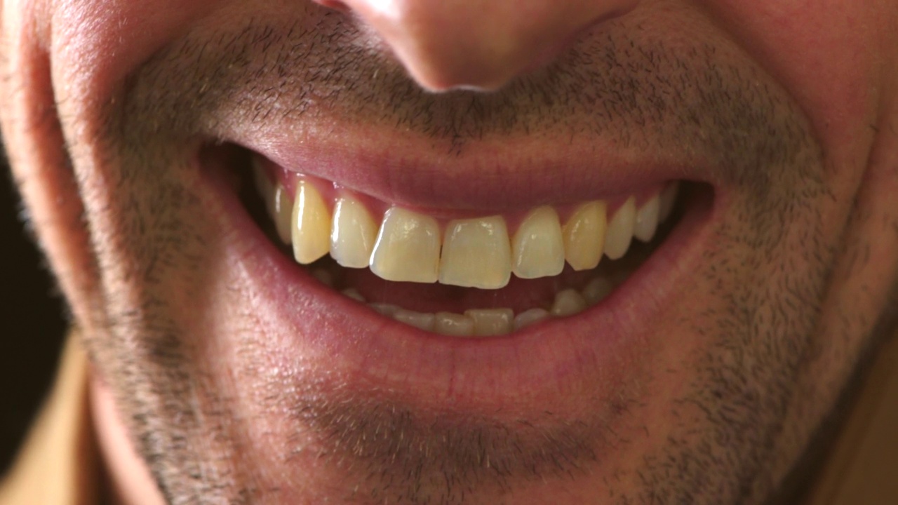 笑着的黄牙齿和胡子男人的口腔特写。一张脸部细节的大头照，一个快乐微笑的男性，下巴和脸颊没有剃光，等待在牙医的美白治疗视频素材