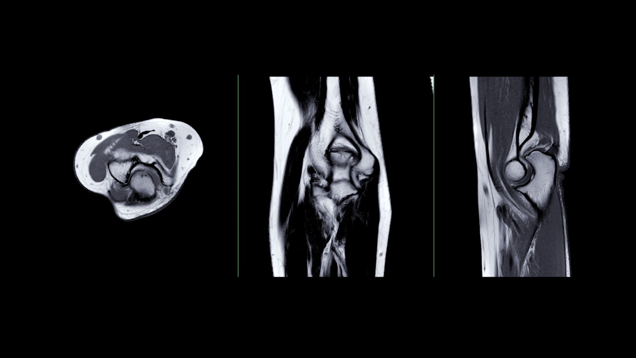 MRI肘关节。视频素材