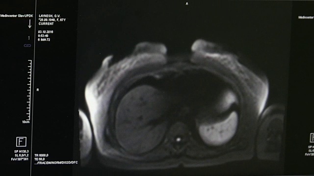 专业医疗设备MRI扫描的脑部断层扫描。视频素材