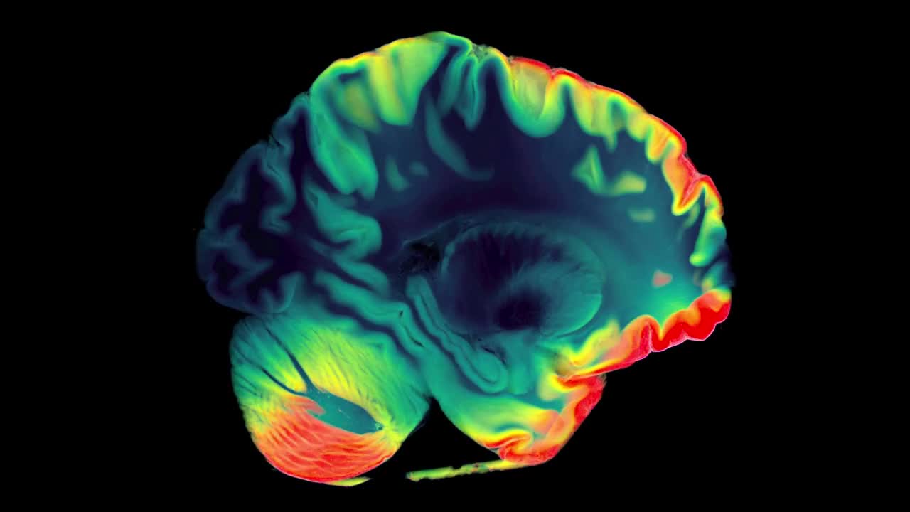 MRA脑或磁共振血管造影术的脑轴向MIP视图显示大脑动脉视频下载