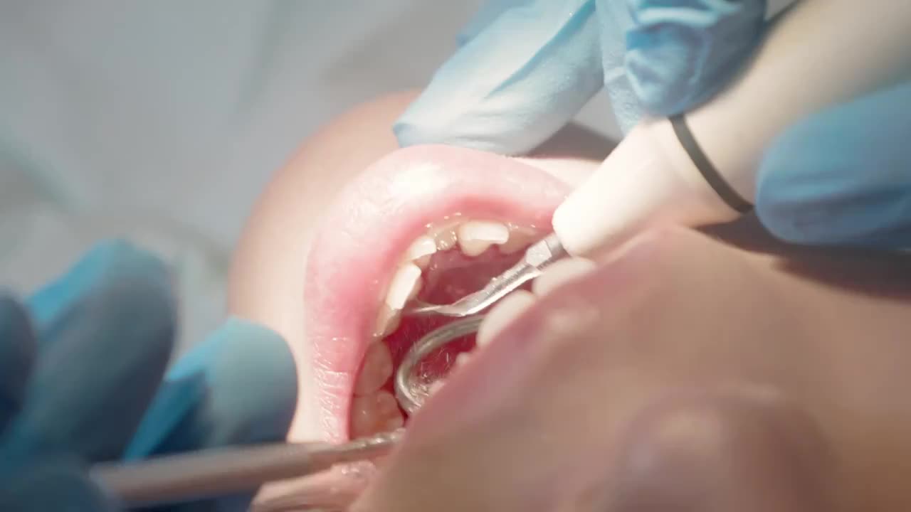 牙医给女性牙齿清洗口腔特写视频下载