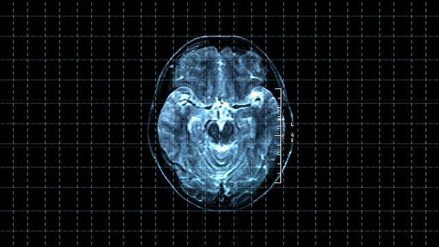 脑部MRT扫描视频素材