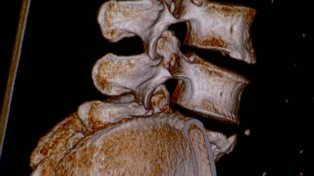 人脊髓和回肠ECU CT扫描/佛蒙特，美国视频下载