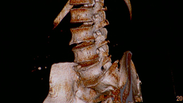 脊髓和回肠的CU CT扫描/ Vermont, USA视频下载