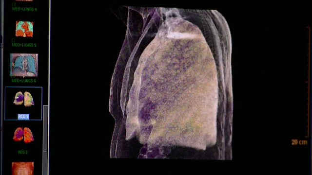 美国佛蒙特州胸部CU CT扫描视频下载
