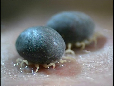 寄生虫/媒介-非洲蜱，人类皮肤上的2只蜱视频素材