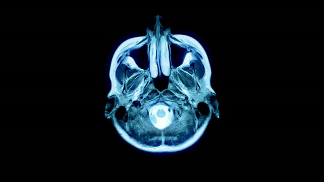 脑MRI扫描-一种诊断方法视频素材