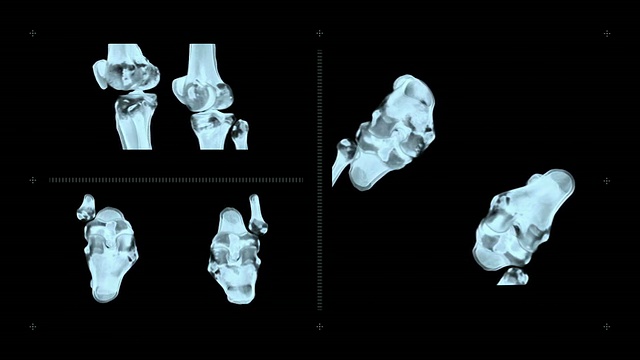 膝关节CT扫描视频素材