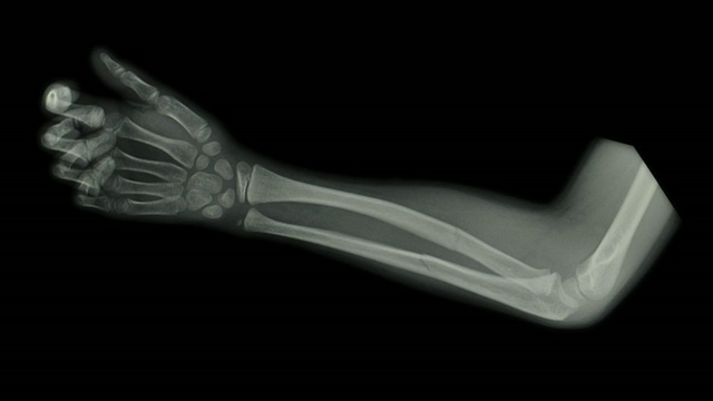 一个七岁男孩的前臂x光片上的ZI显示前臂骨折视频下载