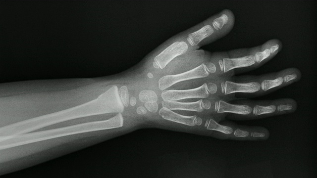 一个三岁女孩手腕x光片上的ZI显示桡骨远端和尺骨的绿枝骨折视频下载