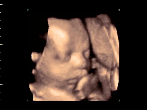 29周龄胎儿打哈欠，4D超声扫描。视频下载