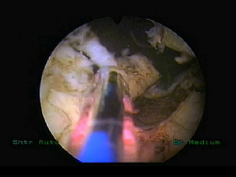 激光前列腺手术。接受前列腺切除术(前列腺切除)的患者尿道内绿光HPS激光的内窥镜图像。引导光是粉红色的，激光是黄色的，死细胞是白色的。视频素材