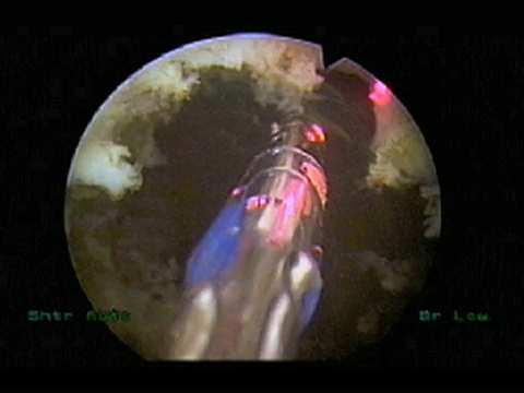 激光前列腺手术。接受前列腺切除术(前列腺切除)的患者尿道内绿光HPS激光的内窥镜图像。引导光是粉红色的，激光是黄色的，死细胞是白色的。视频素材