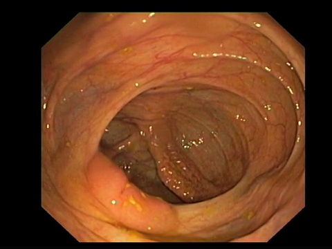 健康的大肠。内镜下健康大肠(结肠)，显示盲肠，回肠盲肠瓣和回肠远端末端。视频素材