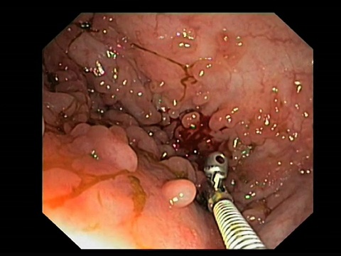 结肠息肉。结肠(大肠)的内窥镜视图显示溃疡性结肠炎患者的炎性息肉。视频素材