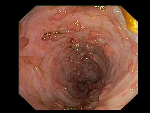 结肠息肉。结肠(大肠)的内窥镜视图显示溃疡性结肠炎患者的炎性息肉。视频素材
