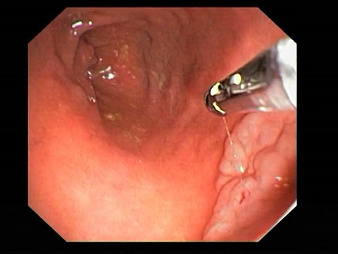癌变前的结肠增长。十二指肠球部良性(非癌)但癌前管状腺瘤的内窥镜视图。视频素材