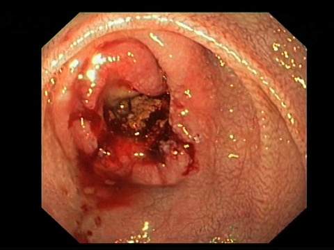 肠癌。腹腔疾病患者小肠内的腺瘤，恶性(癌变)肿瘤的内窥镜视图。视频下载