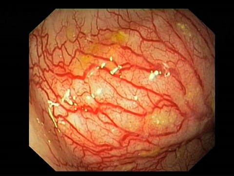 血管异常。大肠开始的盲肠血管异常的内窥镜视图。视频素材