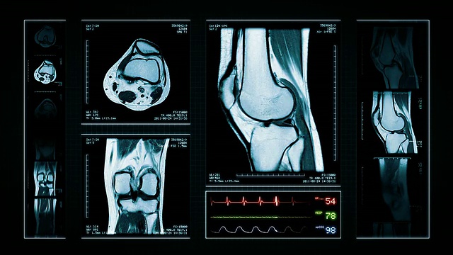 膝关节MRI扫描。顶部，正面和侧面视图。蓝色的。视频下载