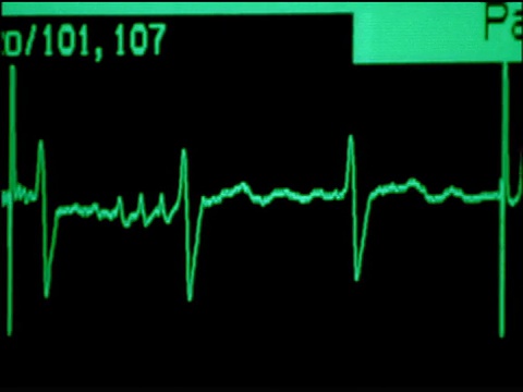 心电图(心脏监护仪)心率图视频下载