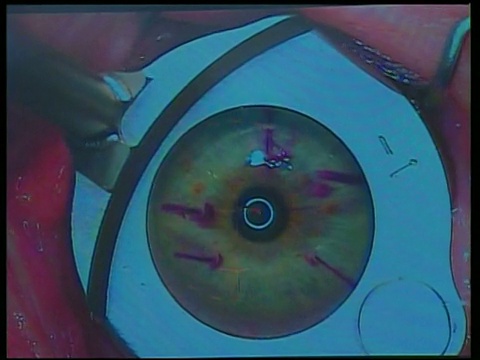 夹在眼球上，为激光眼科手术做好粉色滤光效果的准备视频下载