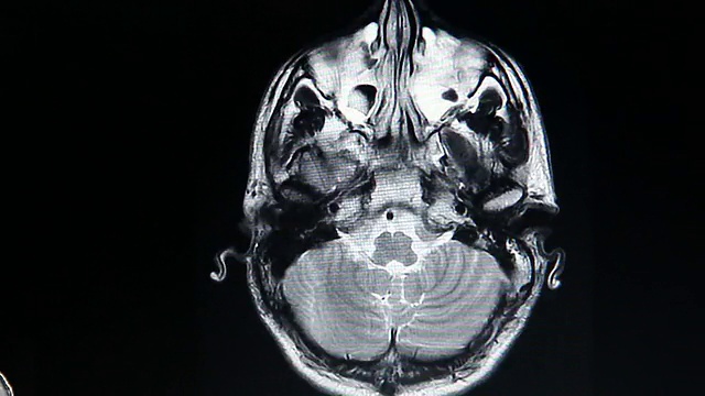 核磁共振大脑扫描视频素材