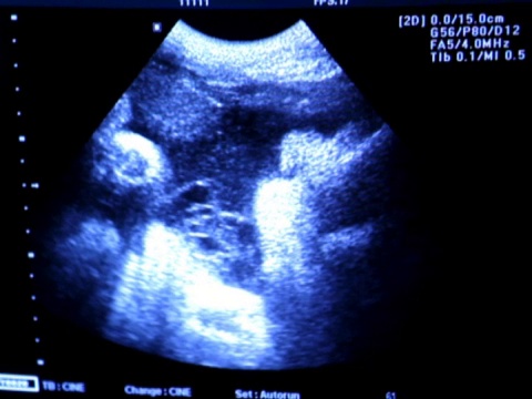 足月婴儿超声检查视频素材
