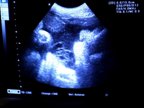 足月婴儿超声检查视频素材
