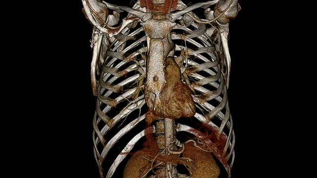 心脏CT血管造影术与人体胸部视频素材