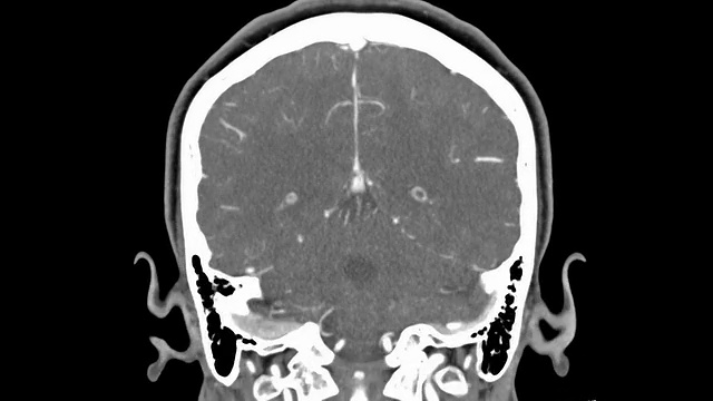 脑MRI扫描视频素材