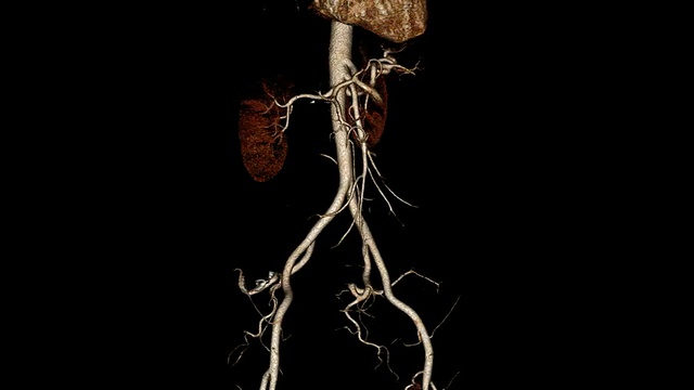 计算机断层扫描血管造影视频素材