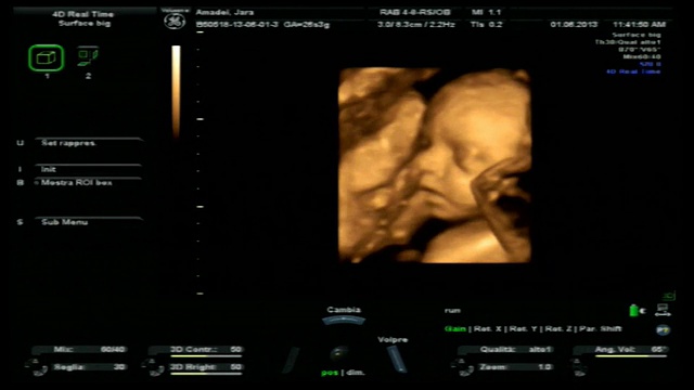 怀孕4 d超声视频素材