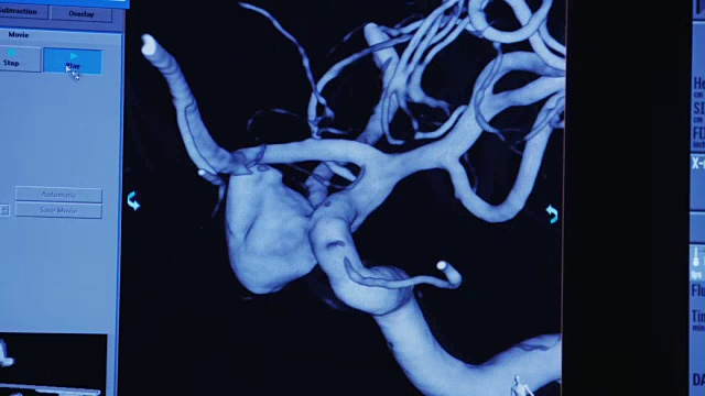 用于动脉瘤插管的人脑动脉的三维旋转诊断图像。视频下载