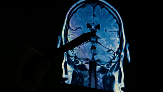脑部扫描MRI 4k视频素材